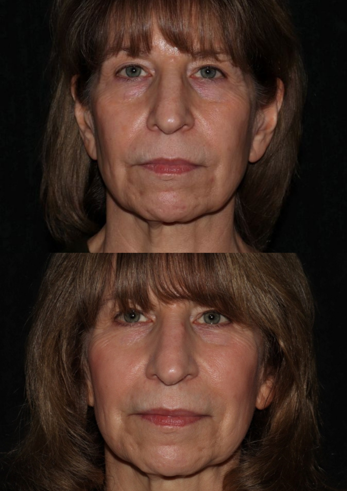 Treatment result