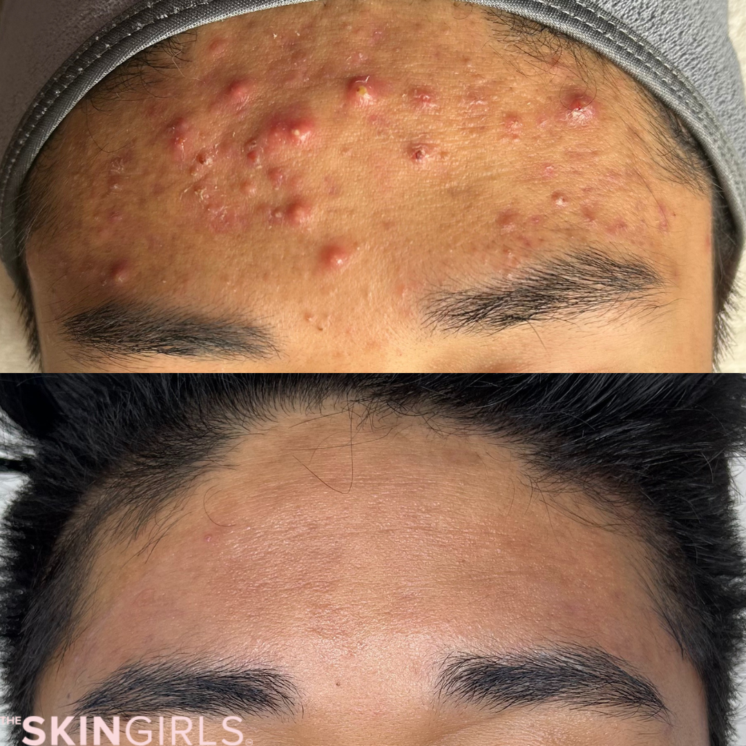 Treatment result