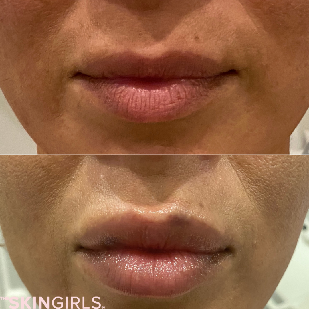 Treatment result