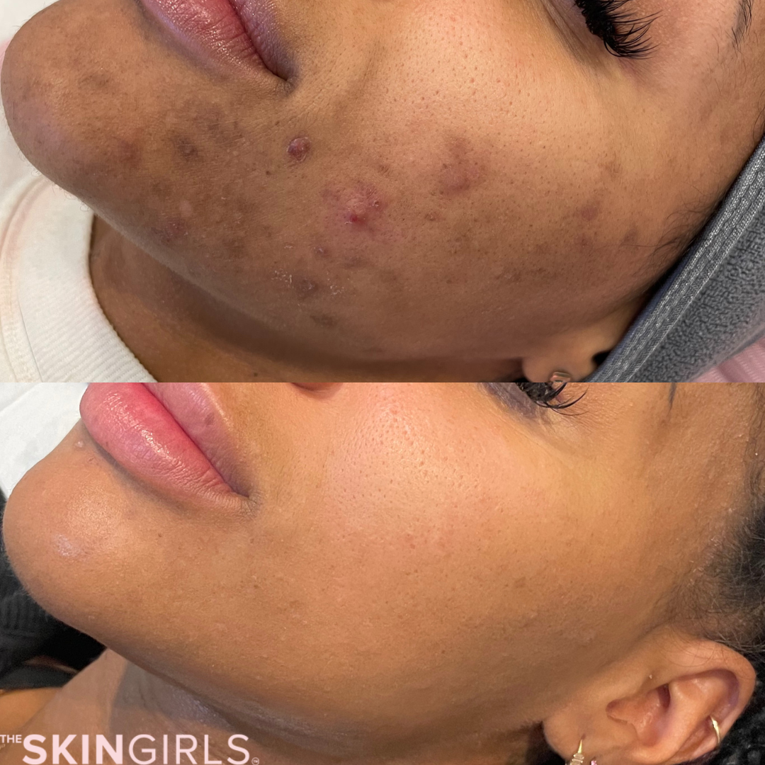 Treatment result