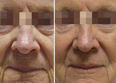 Treatment result
