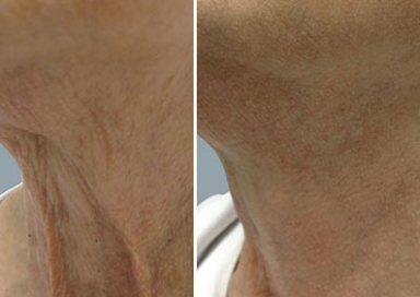 Treatment result