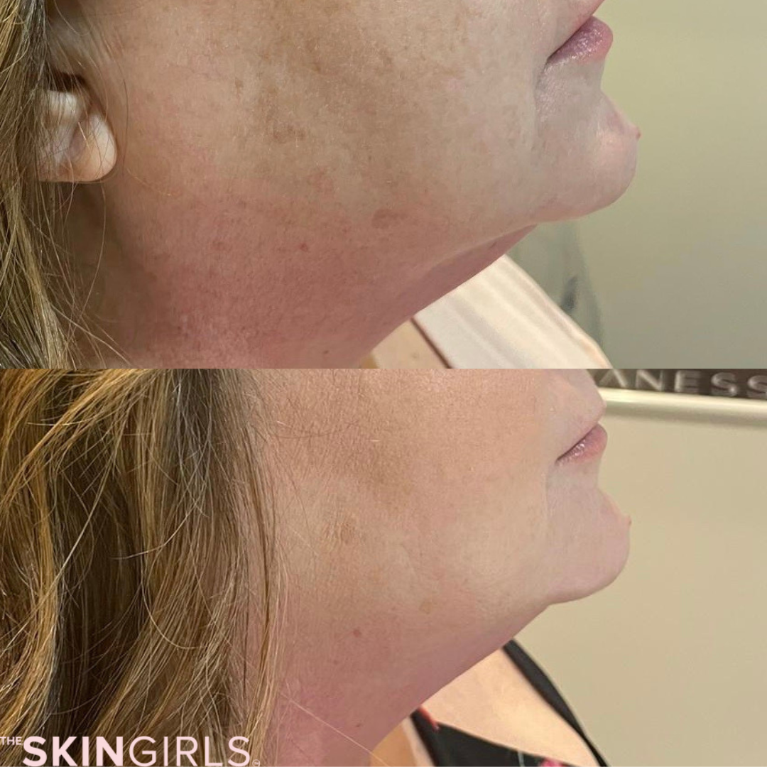Treatment result