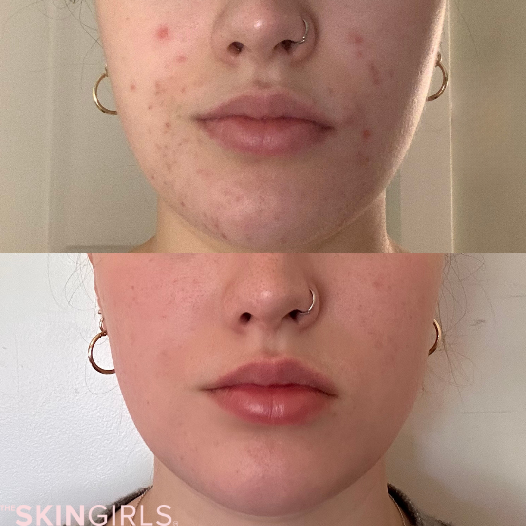 Treatment result