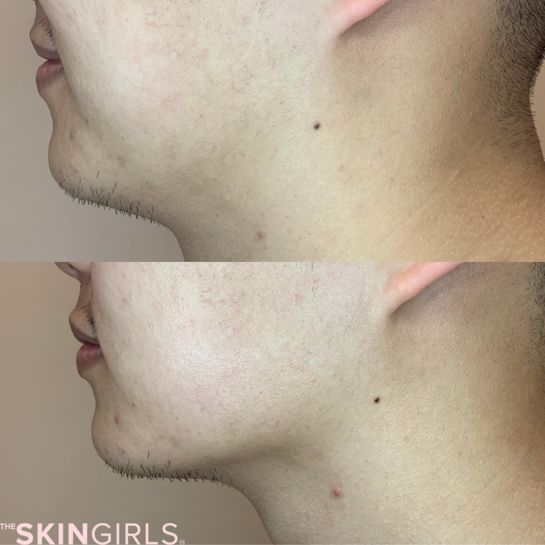 Treatment result