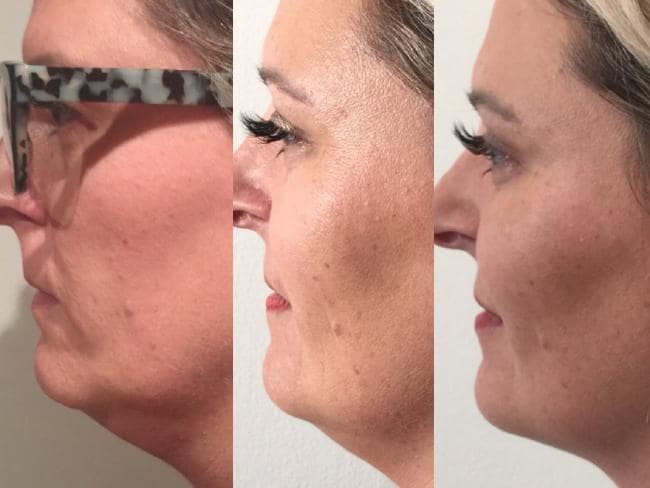 Treatment result