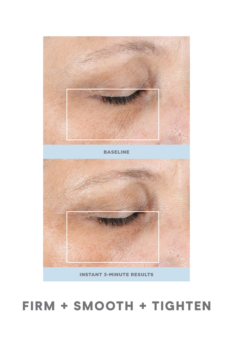 NuFACE FIX®