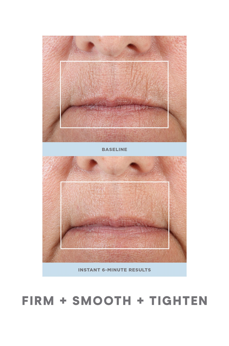 NuFACE FIX®